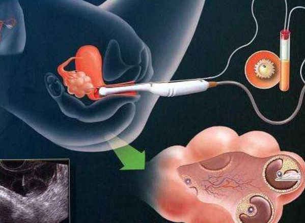 一张照片说明了一个借卵做供卵自怀医院母亲的艰辛